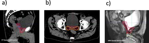 Estroacrop Guideline On Prostate Bed Delineation For Postoperative