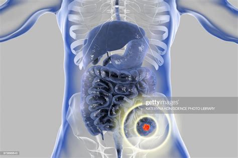 Colon Cancer Treatment Conceptual Illustration Illustration Getty Images