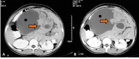 Ab Axial Contrast Enhanced Ct Scan Showing Heterogeneously Enhancing