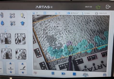 Follicular Unit Extraction Robotic FUE ARTAS IXi