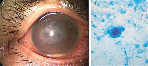 Acanthamoeba Keratitis