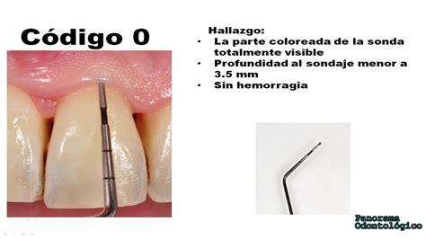 Examen Periodontal B Sico Youtube