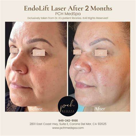 Endolift Pain Free Skin Tightening Fat Reduction Solution