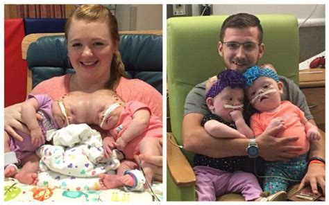 Philadelphia Conjoined Twins Get Ready To Go Home After Surviving Rare Separation Surgery