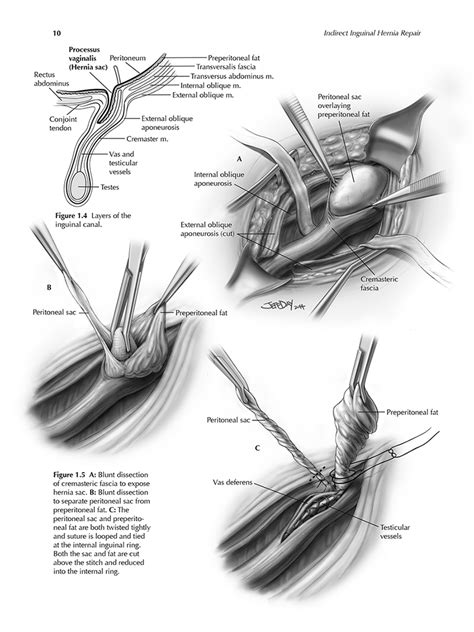 Inguinal Hernia Repair — Jeff Day Art