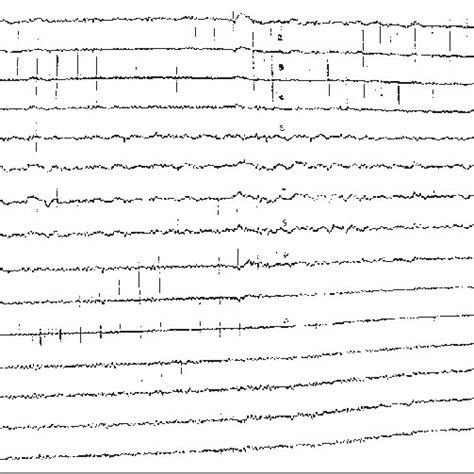 Eeg Que Muestra Pled En La Región Frontotemporal Izquierda Con