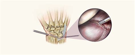 Arthroscopic Surgery - Miami Hand Center