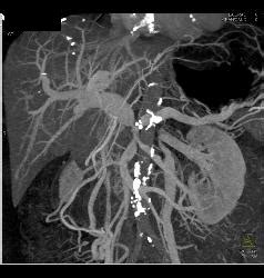 Pancreatic Cancer Encases Pv Smv Splenic Vein Confluence Collateral