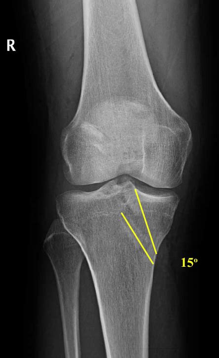 Radiograf A Simple De Rodilla Proyecci N Anteroposterior Se Identifi