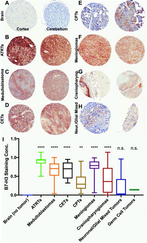 B7eH3 Expression In Pediatric Brain Tumors AeH Representative