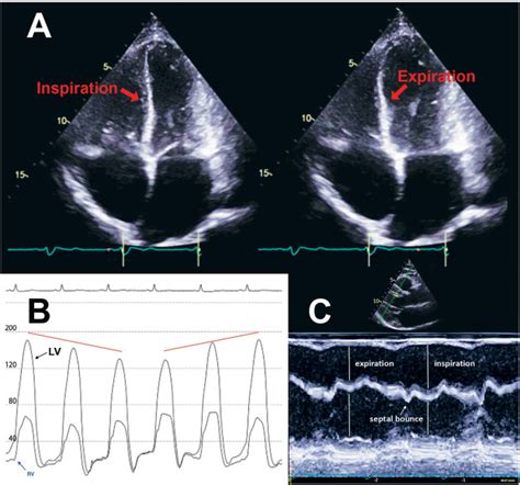 Echocardiographic Patterns Of Abnormal Septal Motion Beyond Myocardial