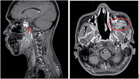 Left: mass on posterolateral sphenoid sinus which infiltrate left and ...