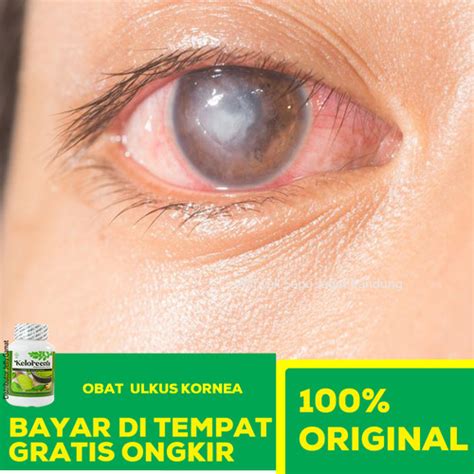 Jual Keloreena 50 Kapsul Obat Ulkus Kornea Mata Katarak Mata