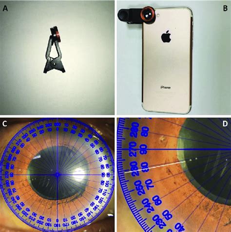 A: Macro lens with customized clip. B: Macro lens clipped onto the ...