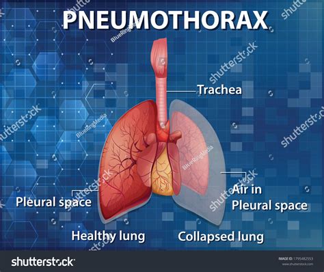 Pneumothorax Collapsed Lung Causes Symptoms And 59 Off