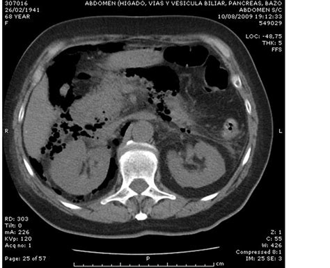 Retroperitoneal Air After Ercp With Sphincterotomy Frequency And