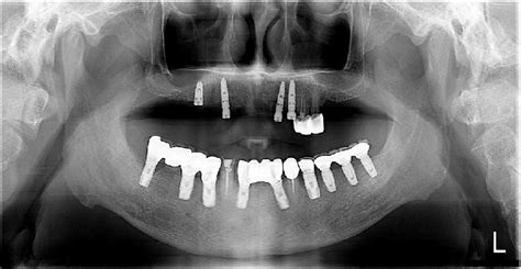 Panoramic radiography demonstrates no remarkable findings. | Download ...