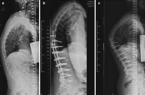 Proximal And Distal Junctional Fixation Techniques Neupsy Key