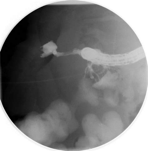 Successful Endoscopic Management Of Postoperative Gi Fistula With