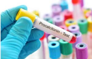 What Is Procalcitonin Beaconlbs