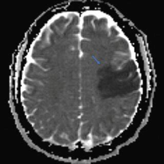 Evolving acute infarct in the left MCA territory as evidenced by the... | Download Scientific ...