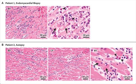 Myocarditis After Covid 19 MRNA Vaccination NEJM