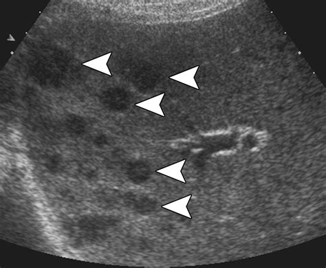 Abdominal Manifestations Of Extranodal Lymphoma Spectrum Of Imaging Findings Ajr