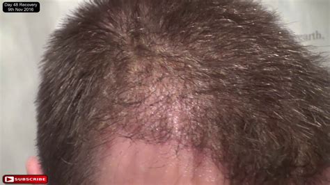 Fue Hair Transplant Day 48 Post Op Recovery Youtube