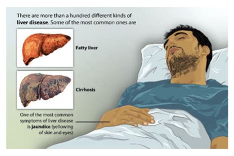 From fatty food to a sedentary lifestyle, all can contribute to liver cirrhosis. Act today