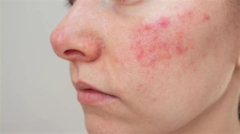 Natural Treatments For Rosacea