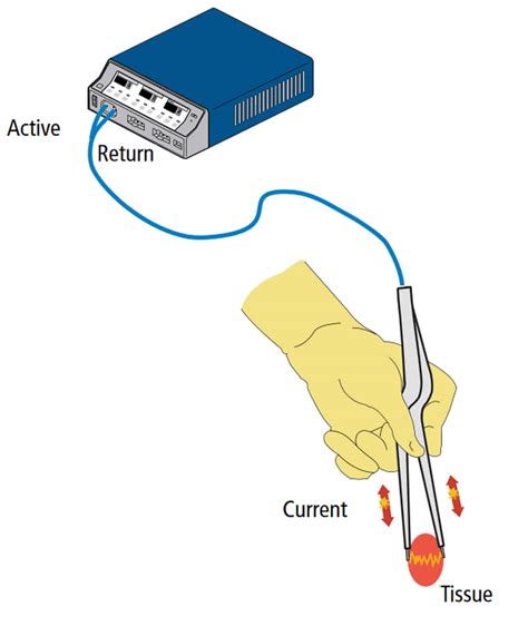 Diathermy Diathermy Therapy Short Wave Diathermy And Diathermy Treatment