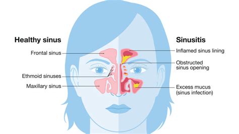 Are Sinus Infections Contagious