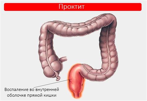 Проктит: симптомы и лечение, профилактика заболевания