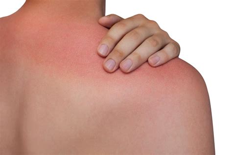 First Degree Burn Definition Symptoms And Treatments