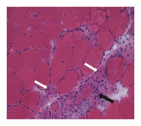 H E Stain Of Quadriceps Muscle Biopsy Showing Muscle Atrophy White