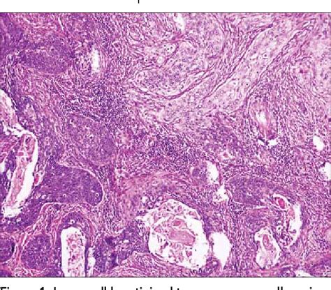 Pdf Adenoid Basal Carcinoma Of Uterine Cervix A Case Report Hot Sex