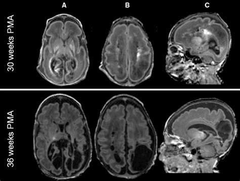 Cystic Periventricular Leukomalacia And Periventricular Hemorrhagic Download Scientific Diagram