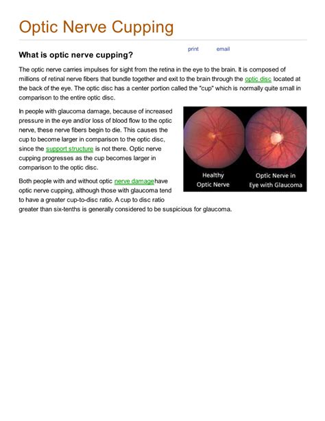 Medical Facts: Optic nerve cupping