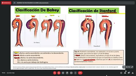 Clase Cirugia Cardiovascular Diseccion Aortica Youtube