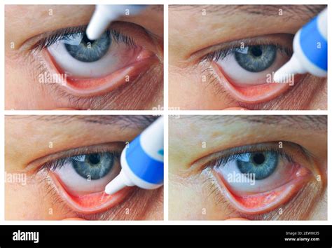 Conjunctival Sac Hi Res Stock Photography And Images Alamy