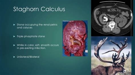 Calculus Disease Renal Stones Radiology