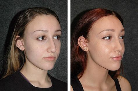 Ultrasonic Rhinoplasty New York Mini Rhinoplasty