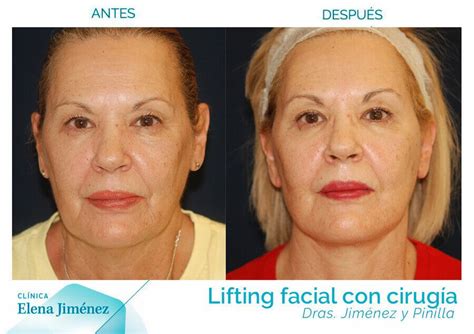 Lifting Facial Y Minilifting En Madrid Mejor Precio Y Resultados