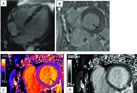 A Male With Cardiomyopathy In His S In Cardiac Mri Left Ventricular