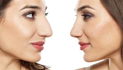 Tout Savoir Sur La Rhinoplastie Ultrasonique