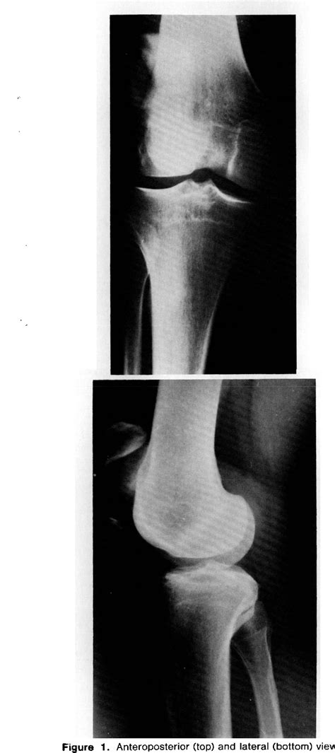 Figure 1 From Acute Dislocation Of The Patella Resulting In A