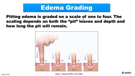 Pitting Edema Scale 1 4