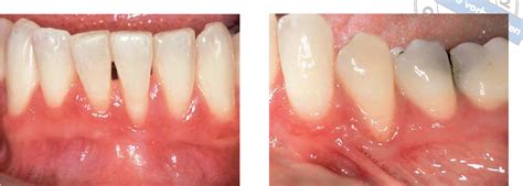 Table From Mucogingival Surgery In A Case Of Chronic Desquamative