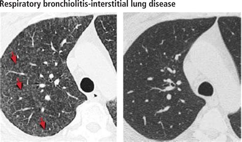 Managing Interstitial Lung Disease Detected On CT During Lung Cancer