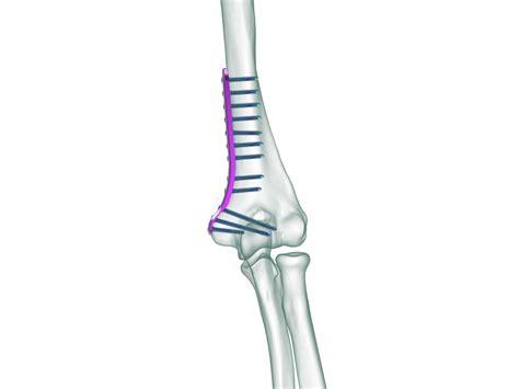 Biomet Distal Humerus Plates